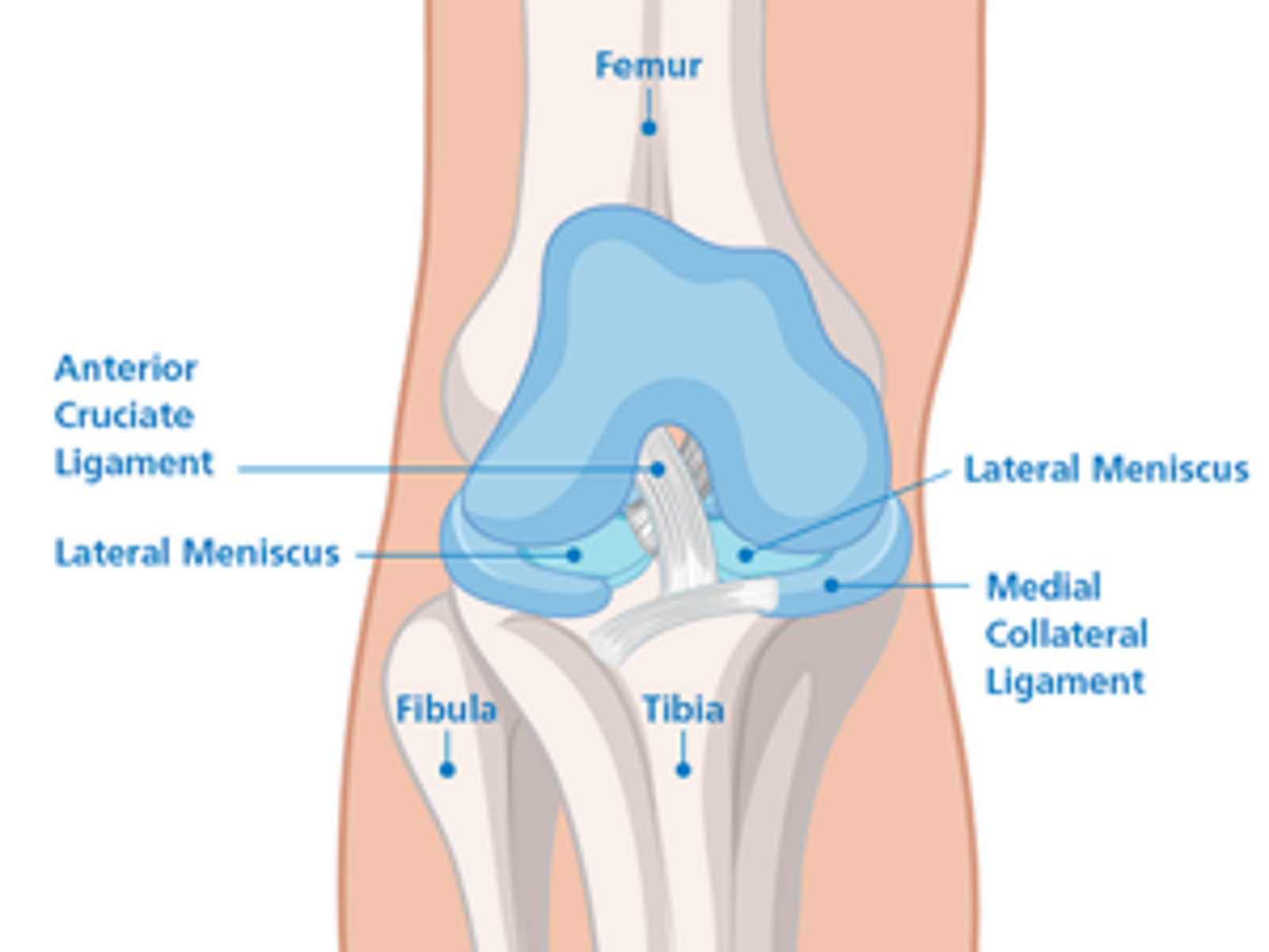 Graphic of a knee showing the femur, anterior cruciate ligament, lateral meniscus, fibula, tibia, medial collateral ligament and lateral meniscuss.